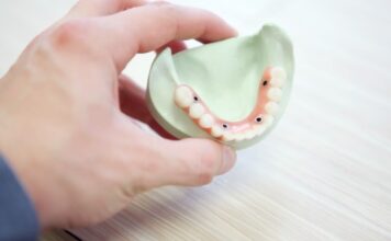 When did dental implants start?